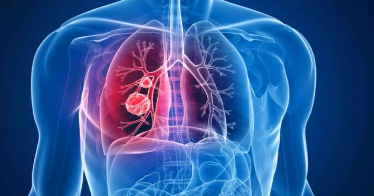 سنويا:  3000 حالة إصابة بسرطان الرئة في تونس